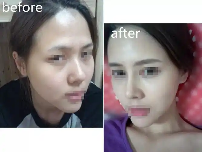 隆鼻前后对比图