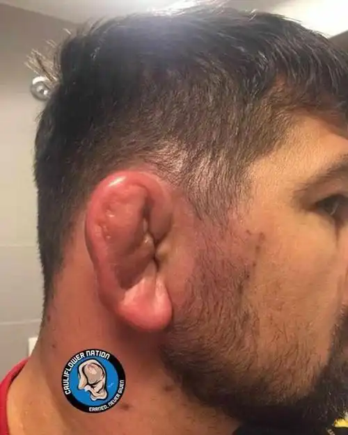 为什么很多ufc选手的耳朵长得像个饺子?真相让人很心酸!
