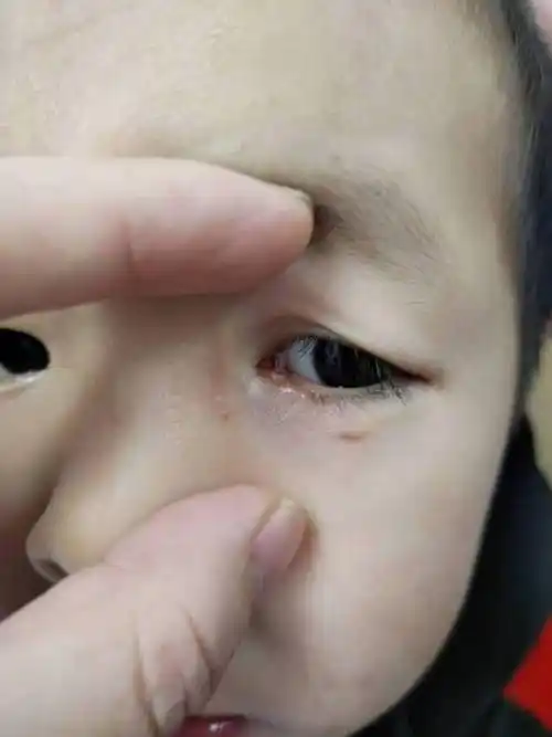 拔引流管泪小管断裂可能导致终身流泪儿童眼外伤应及时救治张冰介绍