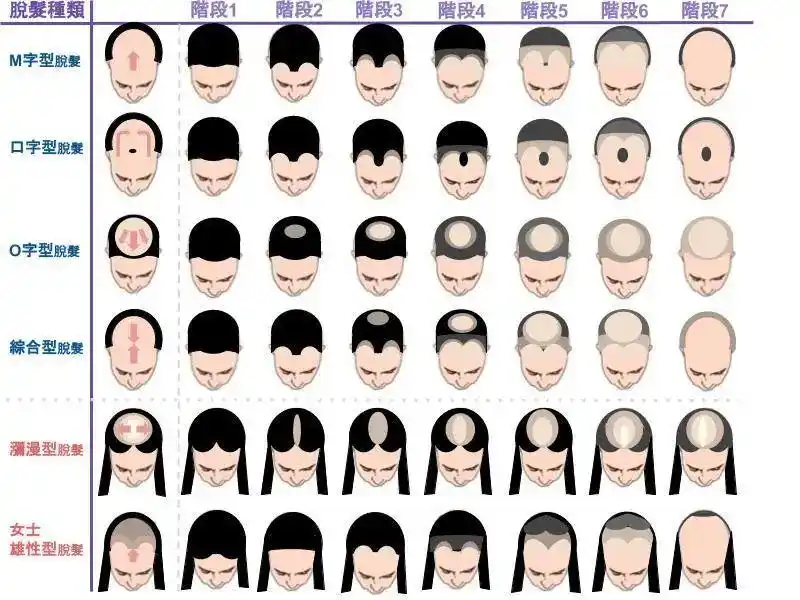 类型中分秃,发际线秃等等包括斑秃,m秃,地中海秃我们日常见过的脱发