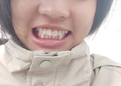 我这算是下面长了颗虎牙吗