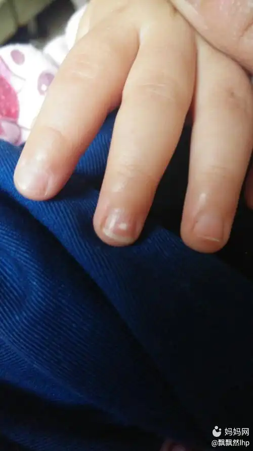 这可能是什么原因(手指甲上的白点与健康的关系)-52线报网