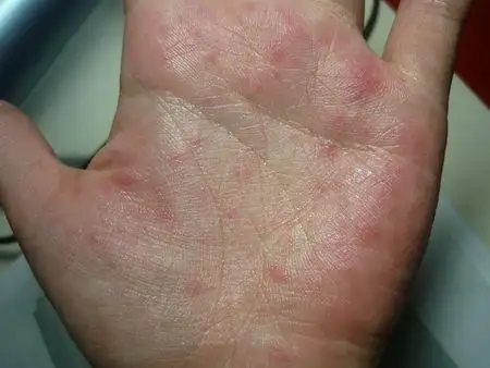 我的手掌为什么会有红斑 我得了什么病