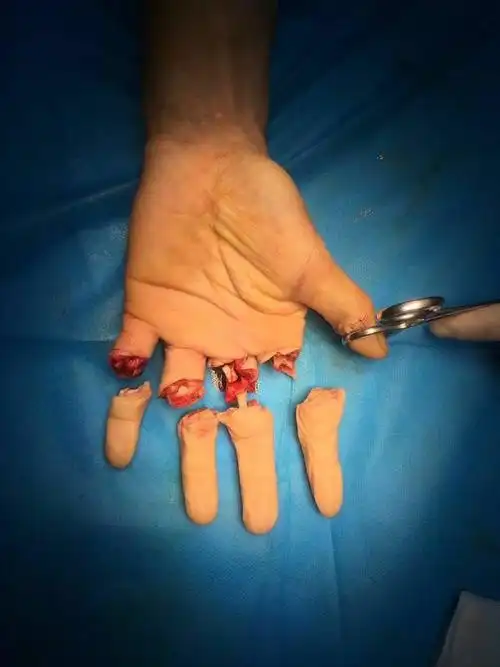 海军971医院(原401)进修结业前报告,切割伤,四指离断.