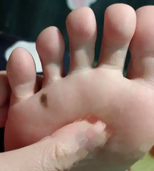 脚底痣