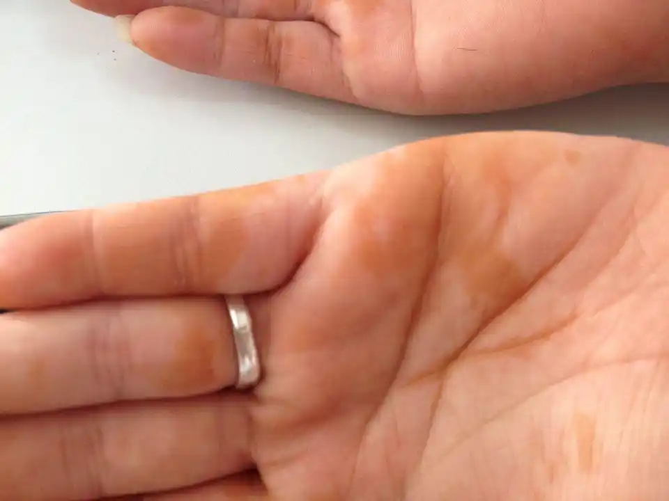 问:昨晚睡一觉,早上起来手上一嘎达一块的变黄色是怎么回事?