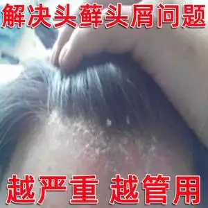 银屑癣外用头部头癣头皮癣真菌感染头藓外用止痒药膏治疗头痒的药