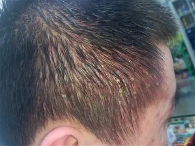 男童头皮毛囊炎康复图片_有来医生