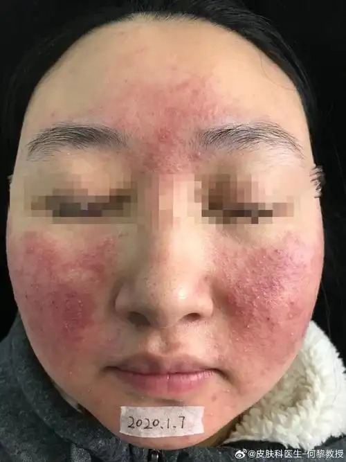 病例分享##走进何阿姨の临床生活#【皮肤屏障的天然保护因子 上】