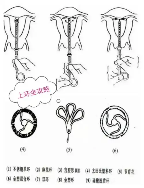 避孕需求嫌带tao麻烦97又担心药物带来副作用的女性朋友00上环就