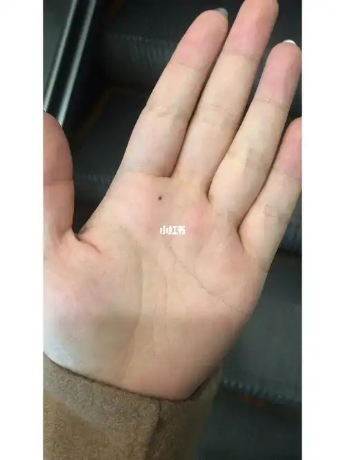 手心痣后续1