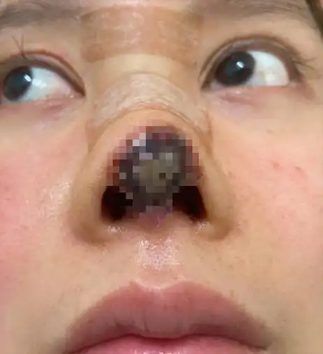 31岁女星整容失败遭毁容,鼻头坏死触目惊心,维权无果欲跳楼