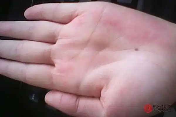 女人手心有痣代表什么