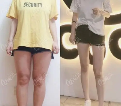 网友晒出腰腹环吸 大腿吸脂三个月前后对比照片10层独栋大楼,诊疗面积
