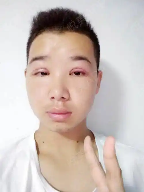 上睑下垂矫正术后1天_全切双眼皮术后1天_眼型矫正术后1天_双眼皮术后