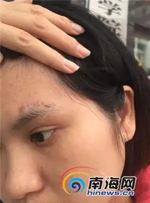 1个多月后伤口冒出线头   医生:不是没拆完线,是里面的线排斥反应所致