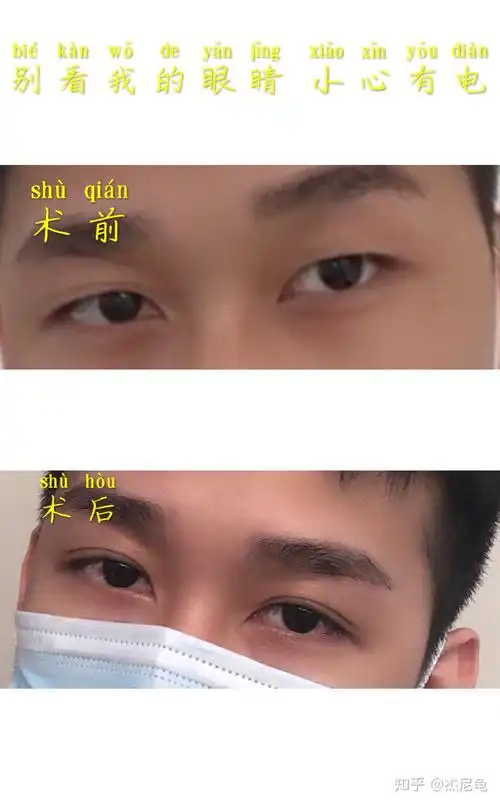 男生割双眼皮恢复一个月能达到可以出门见人的程度吗