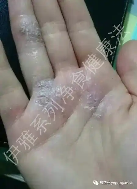 【净食案例】——调理神经性湿疹,过敏性皮炎,荨麻疹 - 伊雅净食