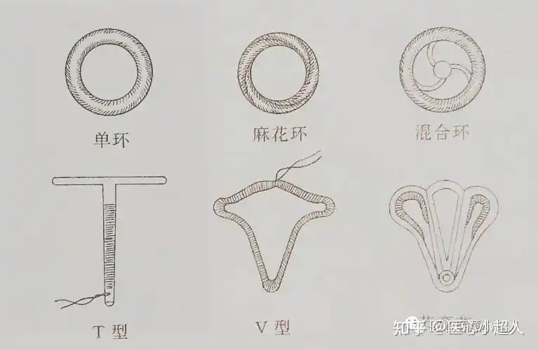 临床上常用的有以下几类:①金属环:包括不锈钢单环,双环,麻花环;②