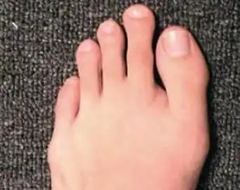 5个脚趾长短看命运图女人二脚趾长的民间说法