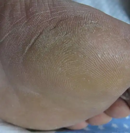 足底皮肤增厚 - 皮肤及性传播疾病讨论版 - 爱爱医医学论坛