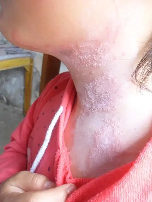 我女儿脖子上是接触性皮炎吗?使用过煤矸石什么药!