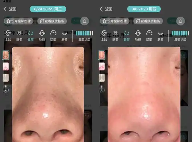 由于孕期没有及时的清洁,导致我鼻子上的黑头越来越多,毛孔越来越粗大