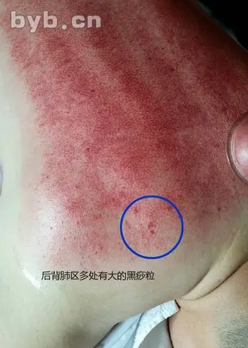 壮汉为啥后背不出汗