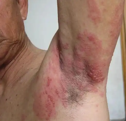 男梅毒初期图片40