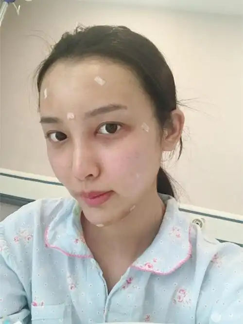 自体脂肪填充全脸三个月恢复效果图真实案例分享