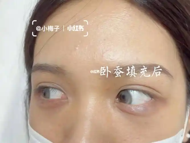 卧蚕玻尿酸填充