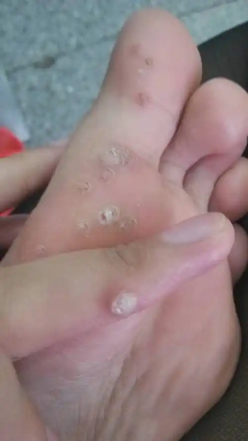 问:这手上和脚上都有鸡眼怎么办?我以前买的鸡眼膏贴的没用