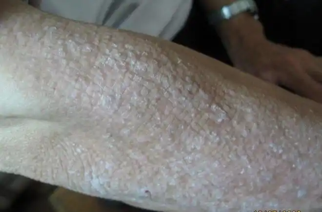 皮肤表面像是撒了一层面粉原来是松皮癣