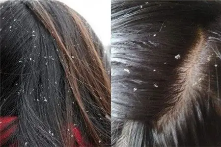 头皮屑多头痒怎么办 盘点那些去头皮屑的方法