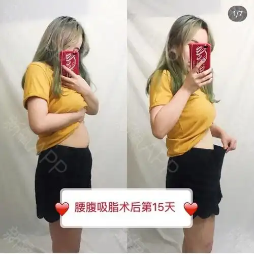 哈尔滨吸脂瘦腰腹好不好_效果图_买辣椒不用券吸脂瘦腰腹术后第15天
