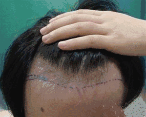 发际线往后一厘米,颜值落后一大圈发际线后移,颜值下降最大的标志是