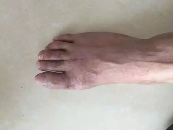 茶陵男子惊现三根脚趾"苦命脚"