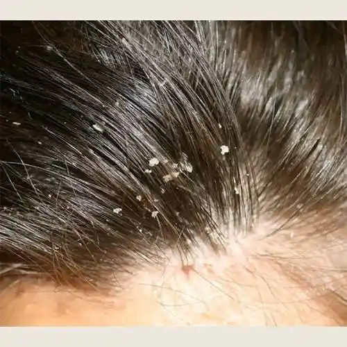 头皮问题产生原因如下:头屑和头皮红疹产生的原因多种多样