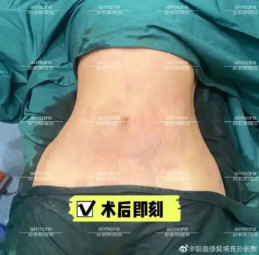 超话产后妈妈腰腹部最容易出现的两个问题,一是脂肪堆积,二是皮肤松弛