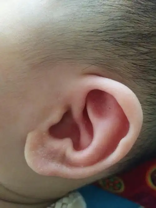 婴儿湿疹长到耳朵里_宝宝耳朵起湿疹怎么办_婴儿湿疹