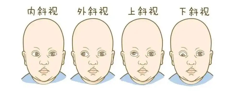 5岁女娃天天上演"歪头杀",家长觉得可爱,医生却说这其实是一种病