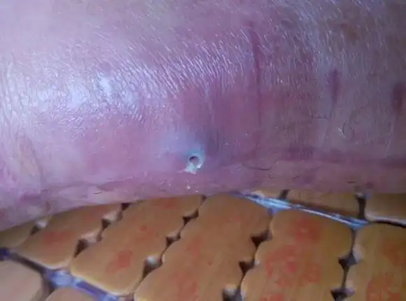 我告诉他,这是手术使用的缝线发生了排异反应,俗称排线头.