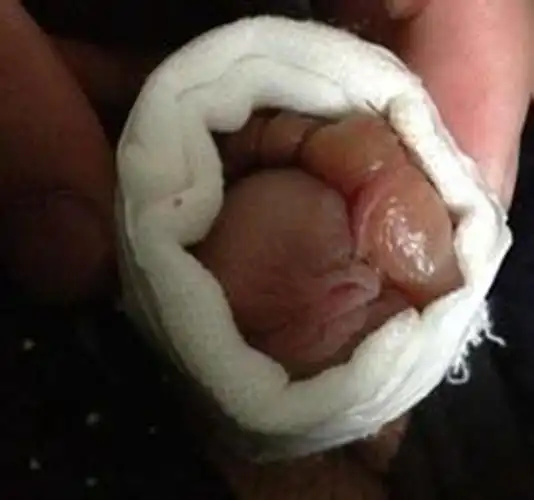 包皮过长手术后龟头图片