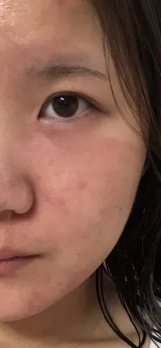 脸部干燥发红干痒 脱皮