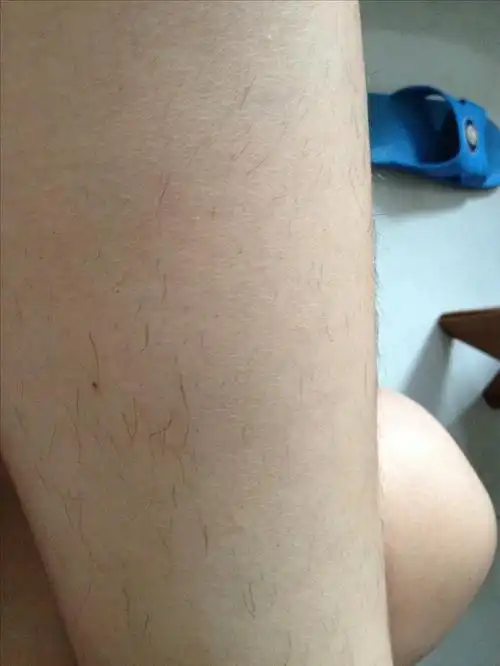 腿毛去除记!