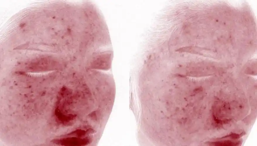 国润生物润品优选商城容易脸红面部红血丝您有可能患有玫瑰痤疮