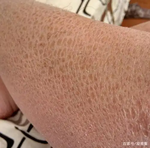 鱼鳞病会有什么危害出现呢