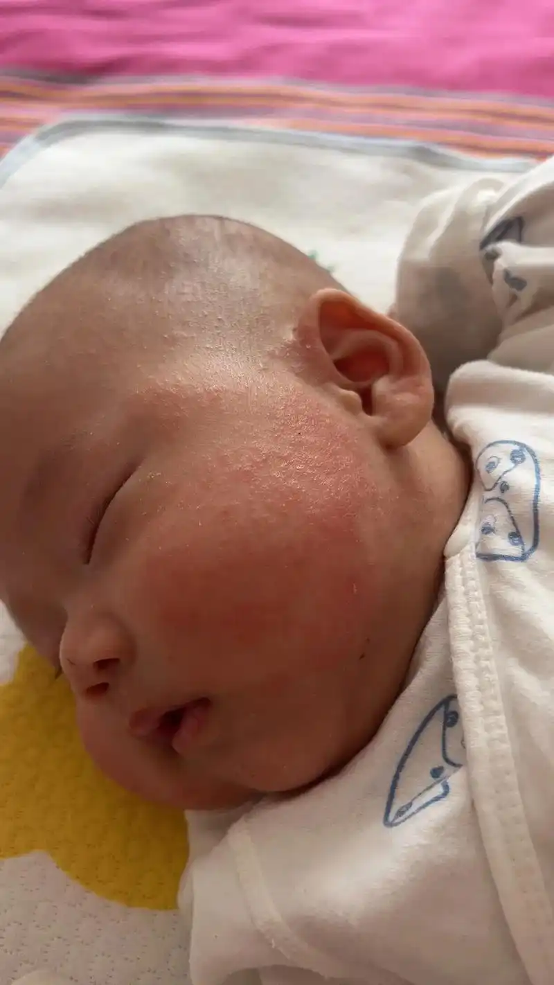 大战湿疹 #小煤气罐罐 鬼知道这两个月经历了什么 - 抖音