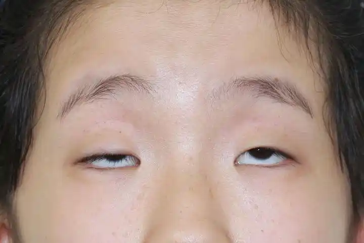 做上睑下垂矫正手术是一种什么体验呢?