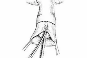 包皮粘连怎么回事_包皮粘连是什么原因_包皮粘连怎么办